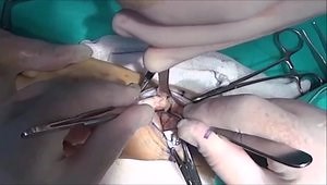 Proximal Row Carpectomy with Dorsal Capsular Interposition Arthroplasty