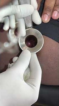 procedure of the proctoscopy