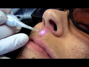 Cold Sore Laser Treatment