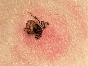 Here’s What a Tick Bite Actually Looks Like