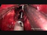 Left Lower Lobectomy by Means of Single Port VATS (Fisureless Technique) • Video • MEDtube.net