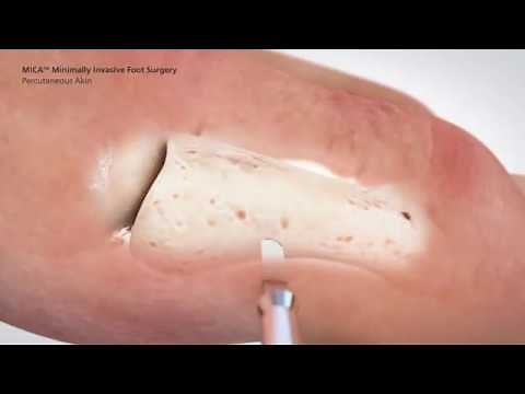 PROstep Surgical Animation: Minimally Invasive Bunion Surgery
