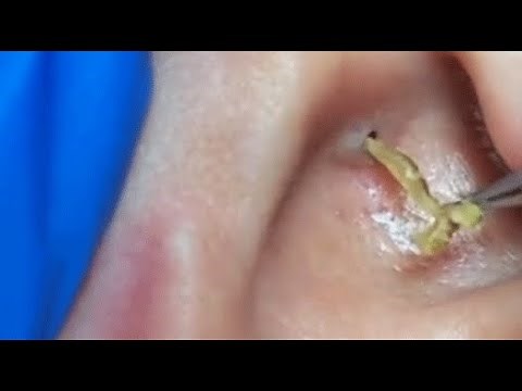 TOP OF BLACKHEADS REMOVAL FROM THE EAR 😨 #2 #relaxing #blackheads