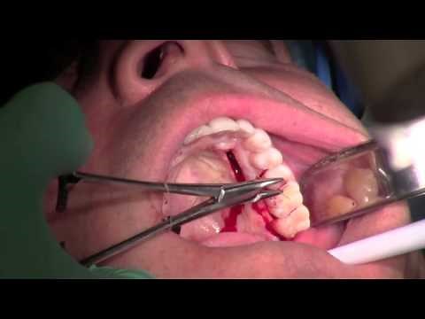 Palatal Gum Grafting