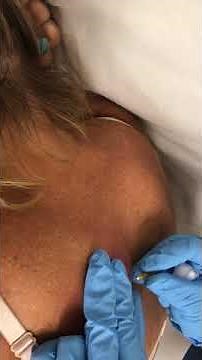 Huge stubborn infected sebaceous cyst squeezing Part 1