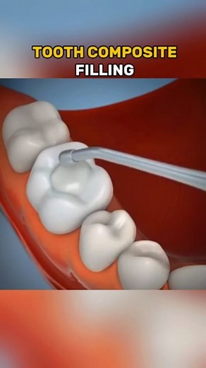 Tooth composite filling 3D Animation video #DentalCare #ToothFilling #OralHealth #3DAnimation #DentalHacks #DentistLife #ToothRestoration #SmileMakeover #CosmeticDentistry #DentalEducation #HealthyTeeth #BeforeAndAfter #TeethTransformation #DentalTech #ViralDentistry | medical 3d animation video