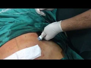Ultrasound guided TAP block