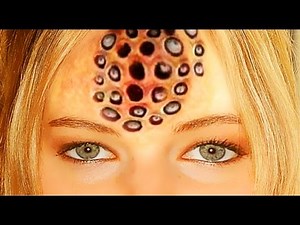 Worlds Worst Trypophobia; What is Trypophobia? Cysts, Acne, Makeup, Pimples Documentary