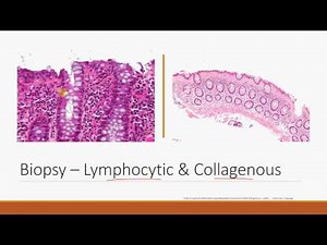 Differentiating the Types of Colitis