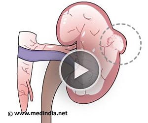 Health Animation - Open Partial Nephrectomy