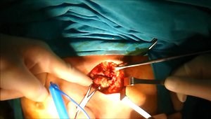 Treatment of Flail Chest, Internal and External Stabilisation