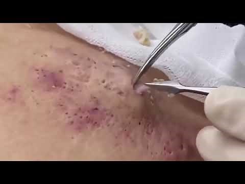 #10 Blackheads on Arm Large Cyst Popping Acne
