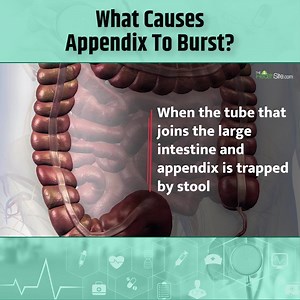 What causes Appendix to burst? #appendix #appendixpain #thsheaalth Disclaimer - The video is meant for informational purpose. It is not intended to be a substitute for professional medical advice diagnosis or treatment. Contact a physician if you have a medical condition | Thehealthsite.com
