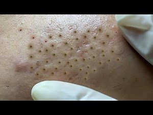 Satisfying video with Hien Nguyen Spa Beauty #024