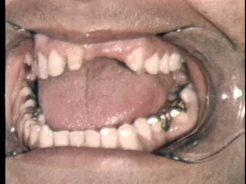 CENTRIC JAW RELATION RECORDS - PART II - FIXED PARTIAL DENTURES AND CROWNS