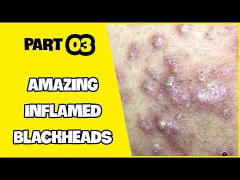 Suri Series 01: AMAZING INFLAMED BLACKHEADS POPPING | PART 3