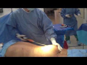 Brazilian Butt Lift - Matthew Schulman, M.D.