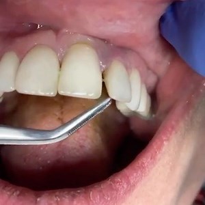  @creativedentalcare • Quick repair of a traumatic injury. The tooth fairy isn’t coming for this one! #creativedentalcare #cosmeticdentist #cosmeticdentistry #topdentist #teethinaday #drbanker #veneers #invisalign #dentalimplants #oralsurgery #botox #babybotox #juviderm #sinuslift #celebritydentist #dentisttothestars #sportsinjury #dentaltrauma #reconstructivedentistry #fullmouthrehab #fullmouthrehabilitation | Dental Mentor | Facebook