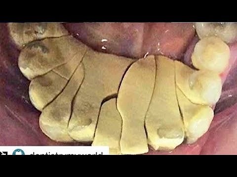 Worst Plaque! 2019's Thickest Tartar & Plaque