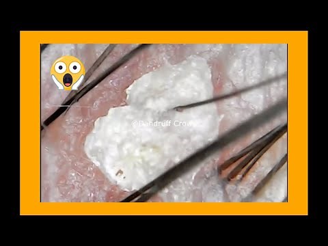 DANDRUFF scalp Exploration| Scalp under MICROSCOPE