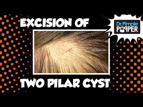 Two GREAT pilar cysts excised by Dr Rebish!
