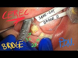 10 Minute CEREC Bridge Preparation POV. GoPro Hero 8. Teeth 28-30. Omnicam and MCXL