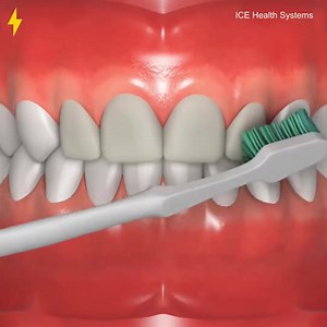 1.9K views · 24 reactions | Wisdom Teeth Extraction & Crowns Cracked 3D Animation | Prince Dr. Moosa bin Shamsher | Facebook