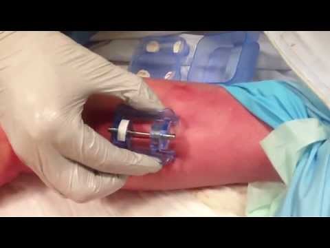 ITClamp Application Demonstration