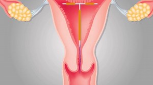 Check out this video on how the Lydia SafeLoad IUD is inserted…#LydiaCares #iPlan | Lydia Contraceptives