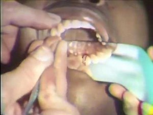 Scaling and Root Planing: Maxillary Teeth