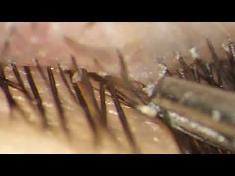 Removing Entire DEMODEX Mites hiding in eyelashes