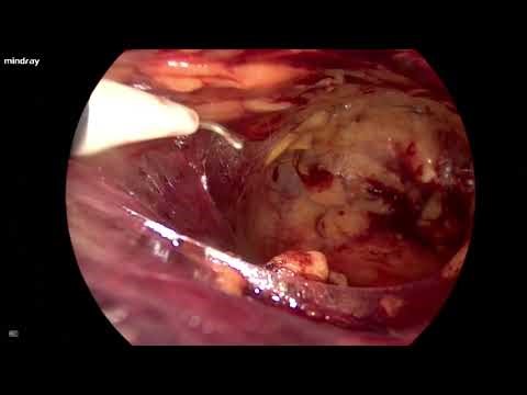 eTEP inguinal hernia repair