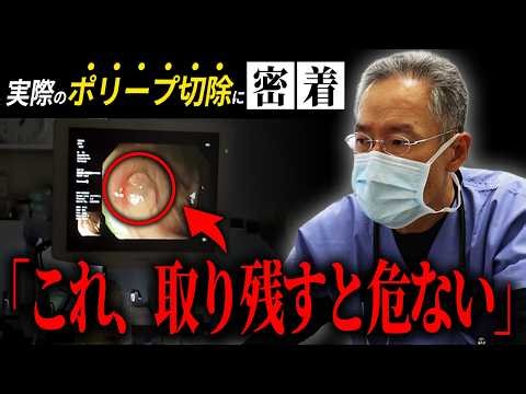 【衝撃の実映像】大腸カメラでポリープをその場で切除…「怖い」を覆す内視鏡の全貌【兵庫県西宮市中島クリニック】