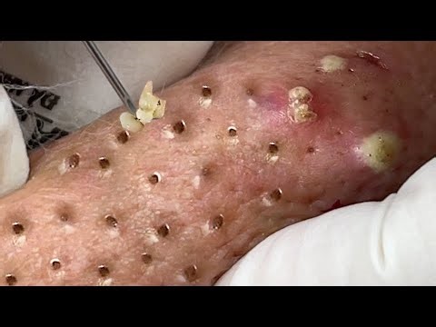 Blackhead Removal With Sac Dep Spa @100074440