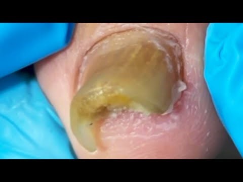 Curl Your Toenails And Trim Them! Get Rid Of Fungus【Crazy pedicure room】