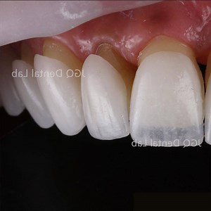 [Hot Item] Cosmetic Dental Restoration Ultra Thin Non-Prep Porcelain Veneers