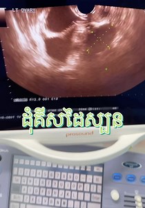 OVARIAN CYSTS ដុំពកអូវែរ គឺជាថង់ ឬថង់ដែលពោរពេញទៅដោយសារធាតុរាវ ដែលដុះនៅខាងក្នុង ឬលើផ្ទៃនៃអូវែរ។ គីសអូវែមានច្រើនប្រភេទ ដែលភាគច្រើនគ្មានការបង្កគ្រោះថ្នាក់ គ្មានរោគសញ្ញា និងបាត់ទៅវិញដោយខ្លួនឯងដោយគ្មានការព្យាបាលក្នុងរយៈពេលពីរបីខែ។ ពួកវាអាចមានទំហំចាប់ពីពីរបីសង់ទីម៉ែត្រដល់ប្រវែងជាងមួយហ្វីត។ ស្ត្រីជាច្រើននឹងវិវត្តន៍ទៅជាដុំគីសក្នុងក្រពេញអូវែ នៅចំណុចណាមួយក្នុងអំឡុងពេលនៃជីវិតរបស់ពួកគេ។ ពួកគេគឺជាហេតុផលមួយក្នុងចំណោមហេតុផលទូទៅបំផុតដែលស្ត្រីស្វែងរកការពិគ្រោះយោបល់ផ្នែករោគស្ត្រី។ 1: Functional Cystប្រភេទcysts ov