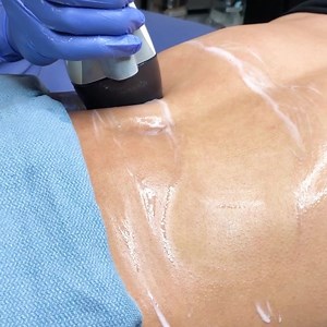 For those who only need to lose a few inches, the VelaShape III may be a complete solution to their body sculpting. The combination of radiofrequency, infrared light, suction, and mechanical massage causes increased metabolism in the fat cells and lymphatic drainage, which in turn results in circumferential reduction. Curious about this treatment? Send us a message to learn more. . . . #velashape #bodyreshaping #skintightening #radiofrequency | Contour Dermatology and Cosmetic Surgery Center