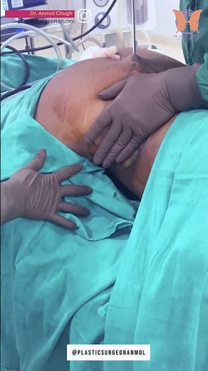 Love Handles Liposuction | Fat Removal Surgery in Delhi NCR