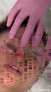 Lucere Smooth Eye A Lucere Personalized Resurfacing Laser treatment designed to: ✔️Improve skin quality around the eyes ✔️Minimize pigmentation ✔️Improve texture ✔️Minimize fine lines & wrinkles ✔️Improve skin tone | Lucere Dermatology & Laser Clinic