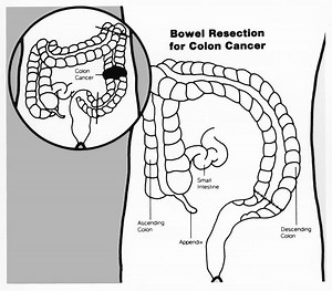 Bowel resection - Alchetron, The Free Social Encyclopedia