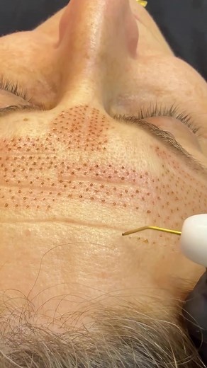 Plasma Fibroblast in Forehead and crows feet