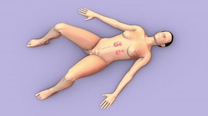 Renal Stones Treated Ureteroscopy Laser Lithotripsy Stock Footage Video (100% Royalty-free) 3431285535 | Shutterstock