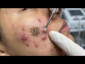 Severe Acne & Blackhead Extraction Compilation