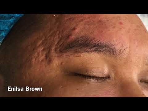 Extractions On The Forehead & Nose