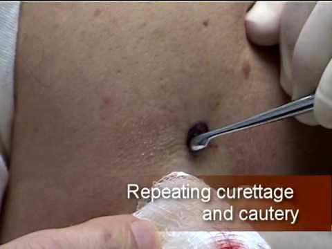 Basal cell curettage and cautery