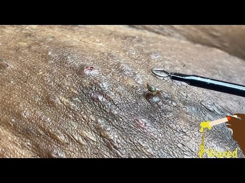 INSANE BLACKHEAD EXTRACTION || INGROWN REMOVAL EP 1