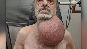 Soccer ball-sized tumor removed from New Jersey man's neck. The cancerous tumor grew from a lump to larger than his head in just 6 months (Video: Mount Sinai Hospital via CNN Newsource) http://bit.ly/3541TSk | FOX26