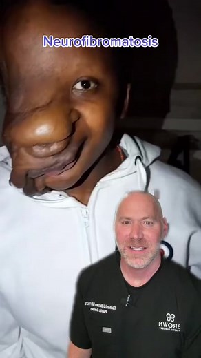 Understanding Neurofibromatosis: Types, Symptoms, and Treatments