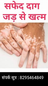 Homeopathic medicine for white patches , Contact Dr Deepak Singh 8295464849 #Homeopathy #ArsenicSulphFlavum #SkinHealth #ChronicCare #HolisticHealing #HomeopathicMedicine #NaturalTreatment #TuberculosisSupport #ImmuneBoost #WellnessCare | Dr. Deepak Singh